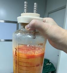 阿坝水动力吸脂手术要做多久？